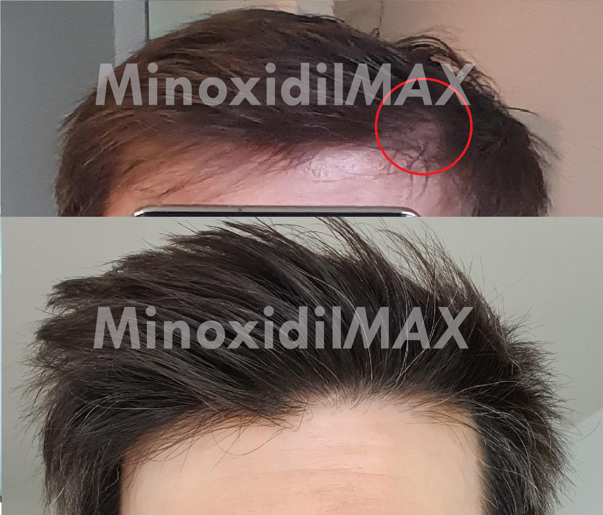 Minoxidil With Finasteride Topical Solution Dualgen With Pg Plus
