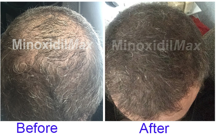 minoxidil results