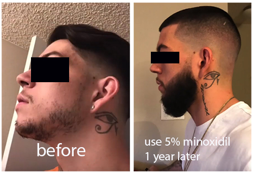 Featured image of post Rogaine For Beard Before And After It stopped after my body adjusted to the minoxidil 2