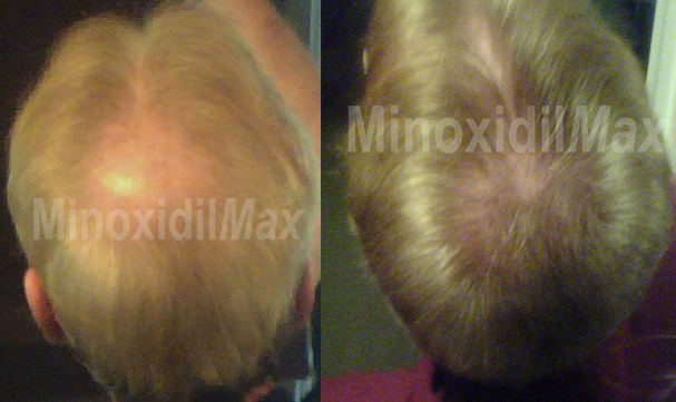 finasteride topical results effects side minoxidil before own without