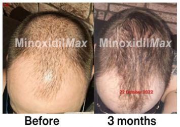 minoxidil results