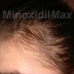 minoxidil_frontal_hair_regrowth_results_after