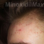 minoxidil_frontal_hair_regrowth_results_before