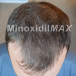 minoxidil_result_after
