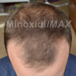minoxidil_result_before