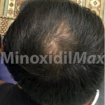 after-minoxidil-only-600