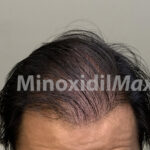 after-maxogen-x