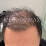 before-maxogen-x